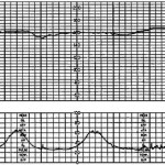 fetal heart tracing loss beat to beat var