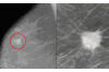 mammogram breast