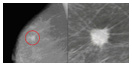 mammogram breast