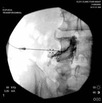 Transforaminal steroid injection neck